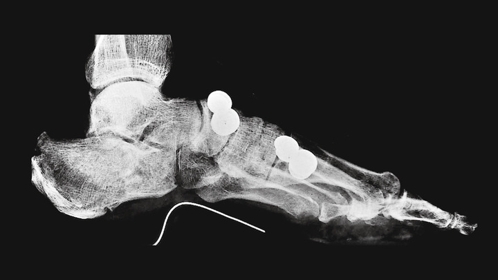 Takılı topuktaki yükü azaltma ortezi ile röntgen resmi