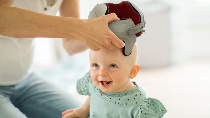 Órtese craniana MyCRO Band impressa em 3D sendo colocada no bebê